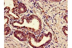 Immunohistochemistry of paraffin-embedded human prostate cancer using ABIN7165494 at dilution of 1:100 (FAM3B Antikörper  (AA 31-235))