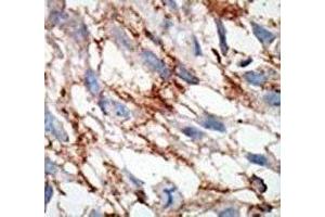 IHC analysis of FFPE human breast carcinoma tissue stained with the ISG15 antibody (ISG15 Antikörper  (AA 31-61))