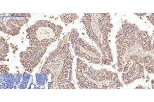 Immunohistochemistry of paraffin-embedded Human lung cancer tissue using CA9 Monoclonal Antibody at dilution of 1:200. (CA9 Antikörper)
