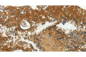 Immunohistochemistry of paraffin-embedded Human breast cancer using MCM4 Polyclonal Antibody at dilution of 1:40 (MCM4 Antikörper)