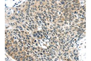 The image on the left is immunohistochemistry of paraffin-embedded Human esophagus cancer tissue using ABIN7192941(TSPY1 Antibody) at dilution 1/40, on the right is treated with synthetic peptide. (TSPY1 Antikörper)