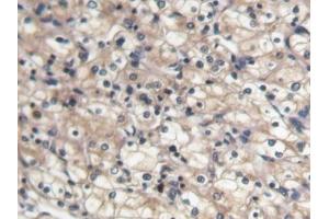 DAB staining on IHC-P; Samples: Human Renal cancer Tissue (BMP7 Antikörper  (AA 30-431))