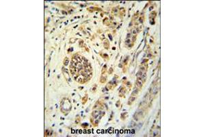 FBXL15 Antibody immunohistochemistry analysis in formalin fixed and paraffin embedded human breast carcinoma followed by peroxidase conjugation of the secondary antibody and DAB staining. (FBXL15 Antikörper  (C-Term))