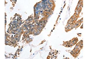 The image on the left is immunohistochemistry of paraffin-embedded Human colon cancer tissue using ABIN7128332(AKR1D1 Antibody) at dilution 1/35, on the right is treated with fusion protein. (AKR1D1 Antikörper)