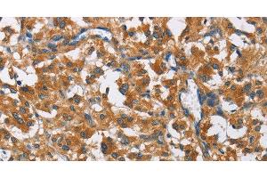 Immunohistochemistry of paraffin-embedded Human thyroid cancer using COPB1 Polyclonal Antibody at dilution of 1:50 (COPB1 Antikörper)