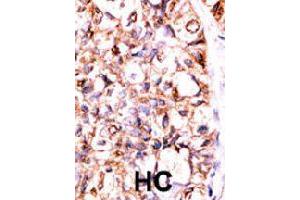 Formalin-fixed and paraffin-embedded human hepatocellular carcinoma tissue reacted with PPP5C polyclonal antibody  , which was peroxidase-conjugated to the secondary antibody, followed by AEC staining. (PP5 Antikörper  (C-Term))