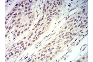 Immunohistochemical analysis of paraffin-embedded esophageal cancer tissues using RUNX3 mouse mAb with DAB staining.