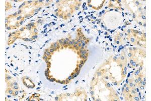 ABIN6265126 and ABIN6272496 at 1/100 staining Human kidney cancer and adjacent normal tissues by IHC-P. (SLC30A2 Antikörper  (Internal Region))