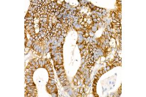 Immunohistochemistry of paraffin-embedded Human colon carcinoma using CD147/BSG antibody (ABIN7265838) at dilution of 1:100 (40x lens). (CD147 Antikörper)
