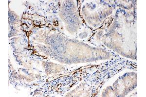 Anti-CD31 antibody, IHC(P): Human Intestinal Cancer Tissue (CD31 Antikörper  (C-Term))