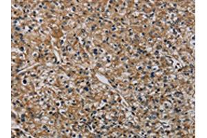 The image on the left is immunohistochemistry of paraffin-embedded Human prostate cancer tissue using ABIN7191019(HSPG2 Antibody) at dilution 1/50, on the right is treated with synthetic peptide. (HSPG2 Antikörper)