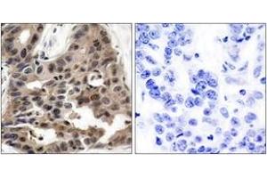 Immunohistochemistry analysis of paraffin-embedded human breast carcinoma tissue, using 4E-BP1 (Ab-36) Antibody. (eIF4EBP1 Antikörper  (AA 4-53))