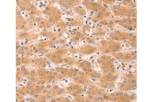 Immunohistochemistry of paraffin-embedded human liver cancer tissue, using GNA11 antibody. (GNA11 Antikörper)