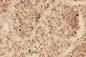 Anti-SOX2 antibody, IHC(P) IHC(P): Human Lung Cancer Tissue (SOX2 Antikörper  (Middle Region))