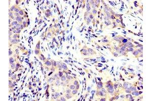 IHC image of ABIN7174344 diluted at 1:200 and staining in paraffin-embedded human pancreatic cancer performed on a Leica BondTM system. (USP48 Antikörper  (AA 358-508))