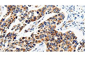 Immunohistochemistry of paraffin-embedded Human lung cancer tissue using COX16 Polyclonal Antibody at dilution 1:50 (COX16 Antikörper)