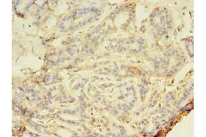 Immunohistochemistry of paraffin-embedded human breast cancer using ABIN7160224 at dilution of 1:100 (SMAD1 Antikörper  (AA 202-335))