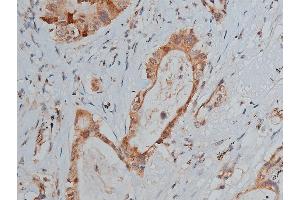 ABIN6267287 at 1/50 staining human lung cancer tissue sections by IHC-P. (p53 Antikörper  (pSer20))