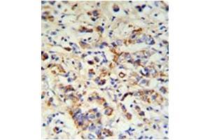 Formalin fixed, paraffin embedded breast carcinoma stained with DCT Antibody (N-term) followed by peroxidase conjugation of the secondary antibody and DAB staining. (DCT Antikörper  (N-Term))