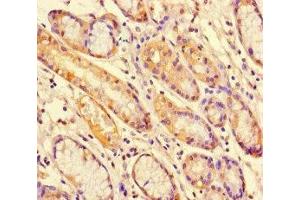 Immunohistochemistry of paraffin-embedded human gastric cancer using ABIN7169664 at dilution of 1:100 (STAT1 Antikörper  (AA 63-196))