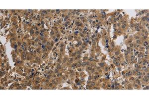 Immunohistochemistry of paraffin-embedded Human liver cancer using KCNMB4 Polyclonal Antibody at dilution of 1:40 (KCNMB4 Antikörper)