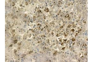 ABIN6258777 and ABIN6273394 at 1/100 staining human melanoma by IHC-P. (CCL24 Antikörper  (C-Term))