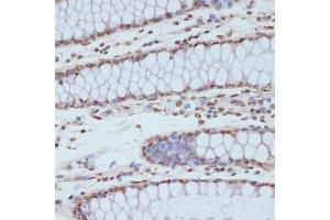 Immunohistochemistry of paraffin-embedded human colon using Phospho-CDK1-Y15 antibody (ABIN3019442, ABIN3019443, ABIN3019444 and ABIN6225371) at dilution of 1:100 (40x lens). (CDK1 Antikörper  (pTyr15))
