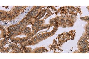 Immunohistochemistry of paraffin-embedded Human gastric cancer tissue using MFAP5 Polyclonal Antibody at dilution 1:40