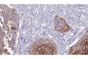 ABIN6277266 at 1/100 staining Human urothelial cancer tissue by IHC-P.