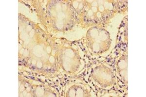 Immunohistochemistry of paraffin-embedded human colon cancer using ABIN7171095 at dilution of 1:100 (SYN1 Antikörper  (AA 113-420))