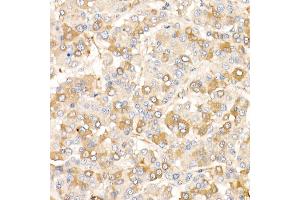 Immunohistochemistry of paraffin-embedded human liver cancer using /AMID Rabbit pAb (ABIN6129888, ABIN6136678, ABIN6136679 and ABIN6215707) at dilution of 1:25 (40x lens). (AIFM2 Antikörper  (AA 1-373))