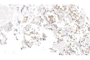 Detection of CK17 in Human Lung cancer Tissue using Monoclonal Antibody to Cytokeratin 17 (CK17) (KRT17 Antikörper  (AA 252-393))