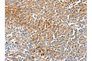 The image on the left is immunohistochemistry of paraffin-embedded Human ovarian cancer tissue using ABIN7191349(MAGEB2 Antibody) at dilution 1/40, on the right is treated with synthetic peptide. (MAGEB2 Antikörper)