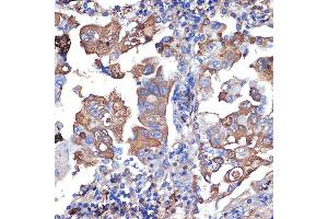 Immunohistochemistry of paraffin-embedded human lung cancer using VPS11 Rabbit mAb (ABIN7271272) at dilution of 1:100 (40x lens).