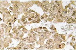 Immunohistochemistry (IHC) analyzes of MEK1 antibody in paraffin-embedded human breast carcinoma tissue. (MEK1 Antikörper)