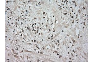 Immunohistochemical staining of paraffin-embedded Carcinoma of kidney tissue using anti-NTRK3mouse monoclonal antibody. (NTRK3 Antikörper)