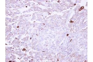 IHC-P Image Immunohistochemical analysis of paraffin-embedded human lung adenocarcinoma Macrophage, using VAP1, antibody at 1:250 dilution. (AOC3 Antikörper)