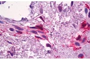 Anti-F13A1 / Factor XIIIa antibody IHC staining of human skin, dermal inflammatory cells. (F13A1 Antikörper)