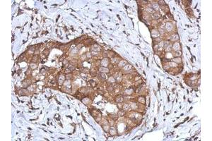 IHC-P Image Immunohistochemical analysis of paraffin-embedded human breast cancer, using CD97, antibody at 1:500 dilution. (CD97 Antikörper)
