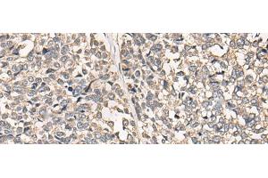 Immunohistochemistry of paraffin-embedded Human esophagus cancer tissue using C12orf40 Polyclonal Antibody at dilution of 1:50(x200) (C12orf40 Antikörper)
