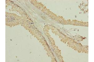 Immunohistochemistry of paraffin-embedded human prostate cancer using ABIN7173055 at dilution of 1:100 (TMEM140 Antikörper  (AA 33-77))