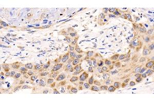 Detection of MCL1 in Human Lung cancer Tissue using Polyclonal Antibody to Induced Myeloid Leukemia Cell Differentiation Protein Mcl-1 (MCL1) (MCL-1 Antikörper  (AA 2-307))
