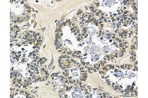 ABIN7097116 and ABIN7101183 at 1/100 staining human ovarian cancer by IHC-P.