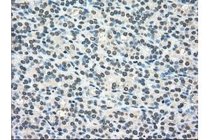 Immunohistochemical staining of paraffin-embedded Adenocarcinoma of colon tissue using anti-SCYL3mouse monoclonal antibody. (SCYL3 Antikörper)