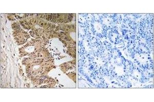 Immunohistochemistry analysis of paraffin-embedded human colon carcinoma tissue, using ZC3H8 Antibody. (ZC3H8 Antikörper  (AA 81-130))