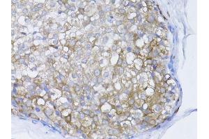 Immunohistochemistry of paraffin-embedded human breast cancer using BRCA1 antibody. (BRCA1 Antikörper  (AA 120-220))