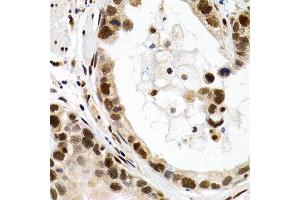 Immunohistochemistry of paraffin-embedded human stomach cancer using MT2A antibody at dilution of 1:200 (400x lens). (MT2A Antikörper)
