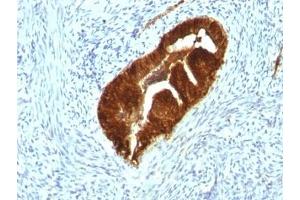 Formalin-fixed, paraffin-embedded human endometrial carcinoma stained with Cytokeratin 19 antibody (KRT19/799 + KRT19/800) (Cytokeratin 19 Antikörper)