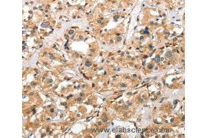 Immunohistochemistry of Human thyroid cancer using CTSE Polyclonal Antibody at dilution of 1:40