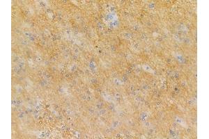 Phospho-SIK2 (Thr484) Antibody at 1/100 staining human glioblastoma by IHC-P.